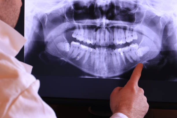 Best Emergency Wisdom Teeth Removal in Golden Triangle, NJ